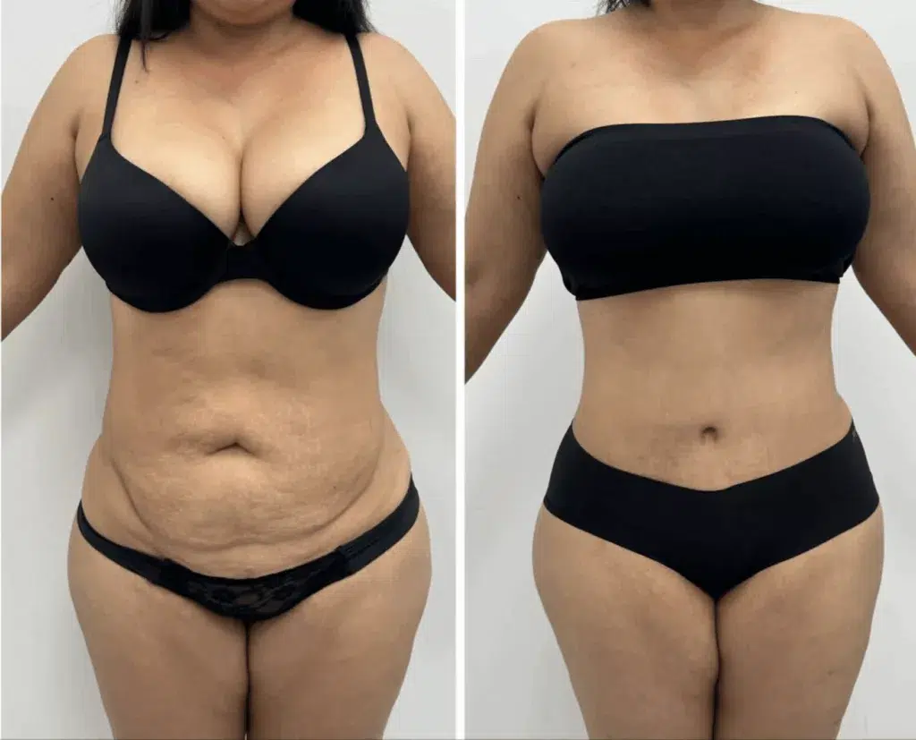 résultat d'une abdominoplastie en avant et en après