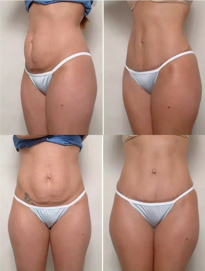 résultat d'une abdominoplastie avant et après 2 mois