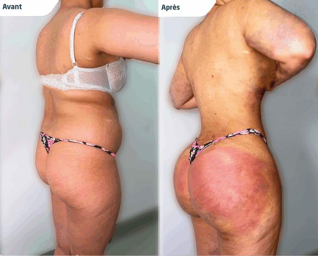 Photos avant et après d'une lipo bbl réalisée en tunisie par silhouette esthetics