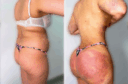 Photos avant et après d'une lipo bbl réalisée en tunisie par silhouette esthetics