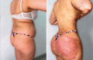 Photos avant et après d'une lipo bbl réalisée en tunisie par silhouette esthetics
