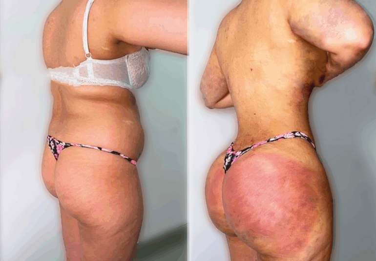 Photos avant et après d'une lipo bbl réalisée en tunisie par silhouette esthetics