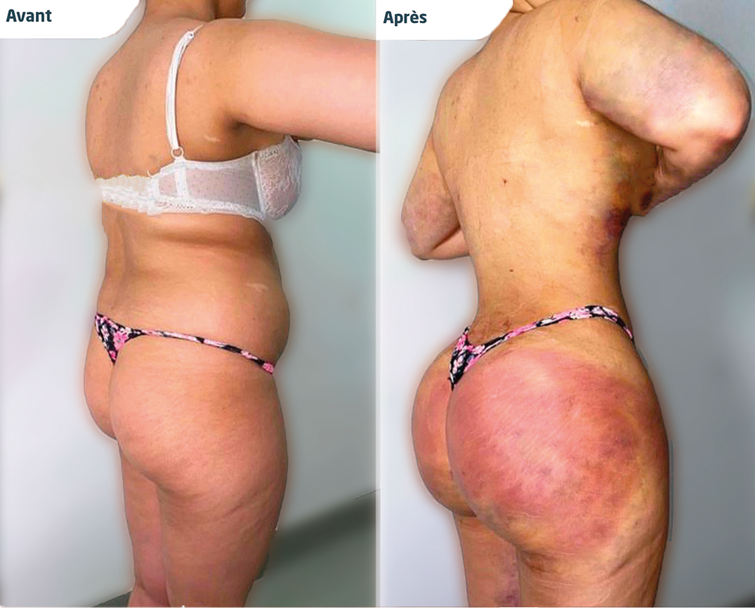 Photos avant et après d'une lipo bbl réalisée en tunisie par silhouette esthetics