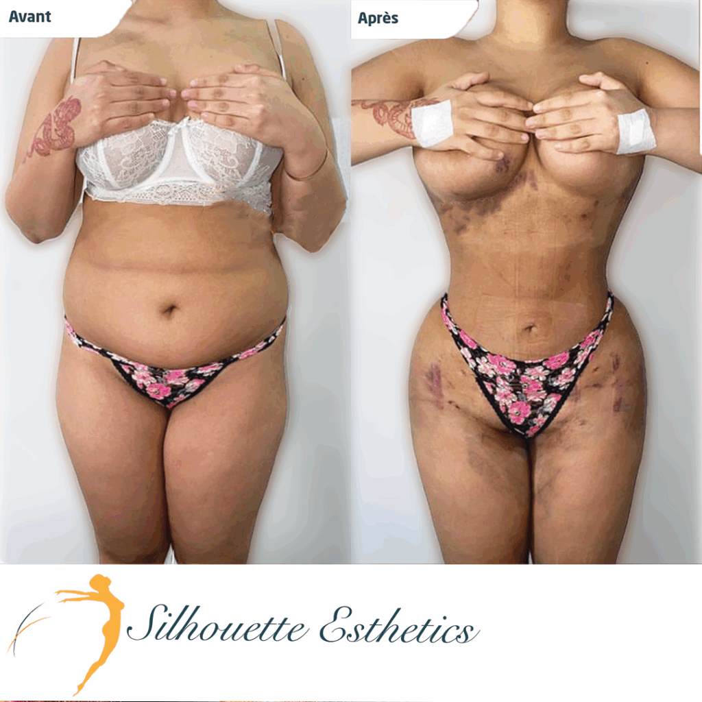 Photos avant et après d'une lipo bbl réalisée en tunisie par silhouette esthetics